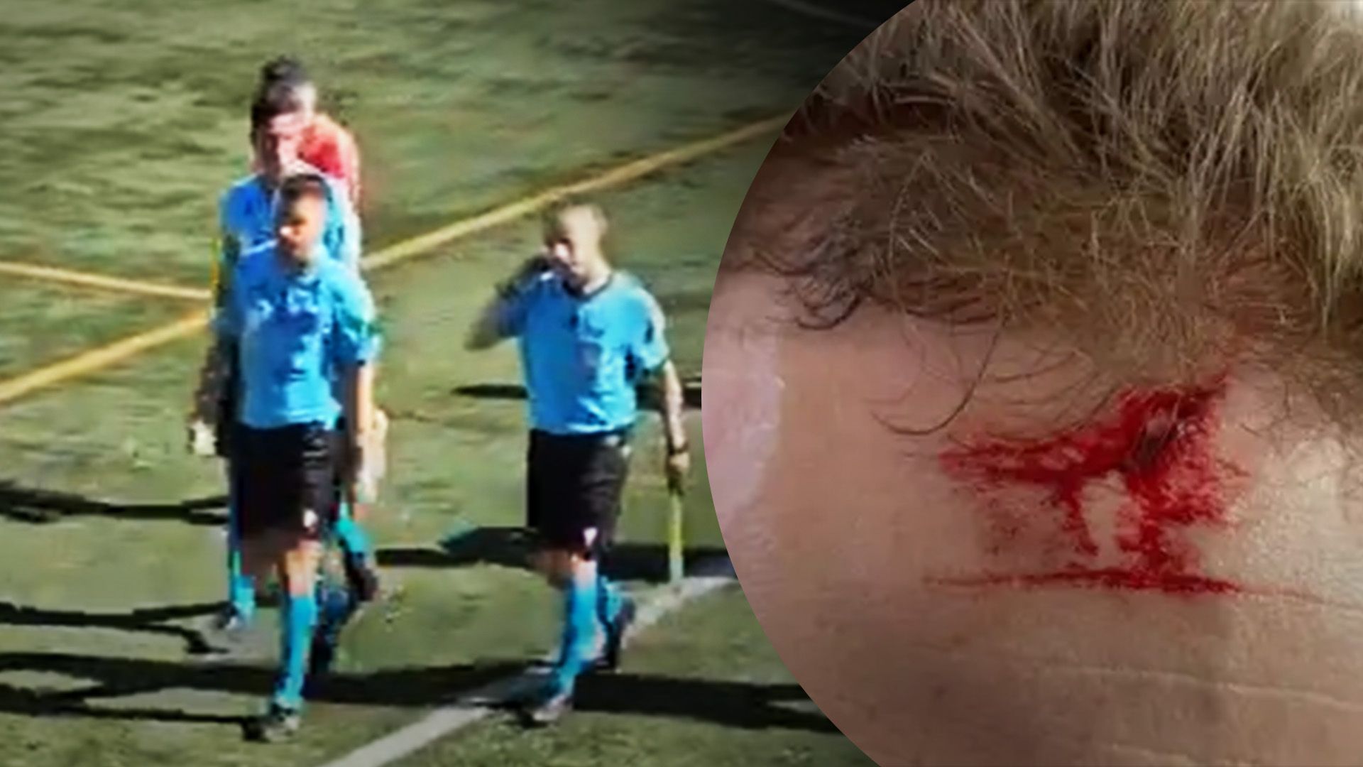 Арбітру розсікли лоб Арбітру розсікли лоб