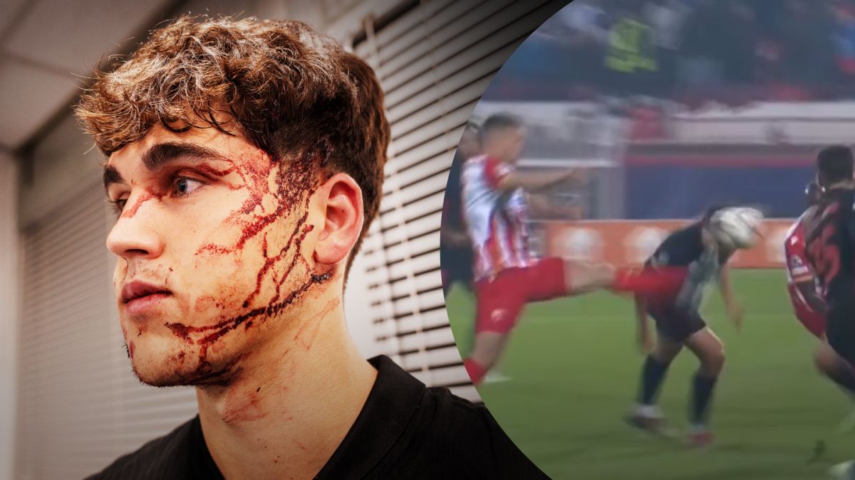 Пау Курбаси разбили лицо в матче ЛЧ - видео момента и фото швов на голове Пау Курбаси разбили лицо в матче ЛЧ - видео момента и фото швов на голове